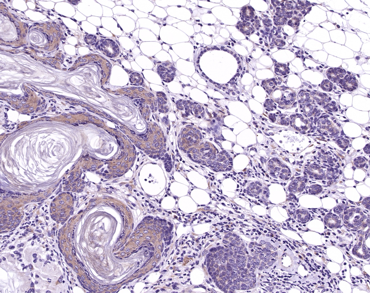 Figure 1. Immunohistochemical detection of TIAM-1 in a mammary gland tumor as detected by MUB1807P.